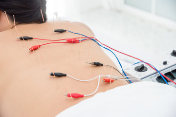 "fisioterapeuta amanos castro urdiales acupuntura electropuncion neuromodulacion"